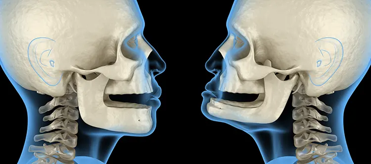 Comparison of normal jaw volume (left) and jaw bone atrophy (right)