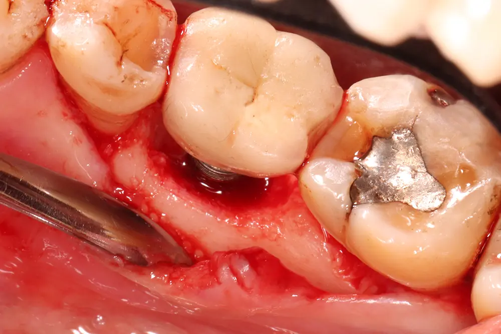 Advanced peri-implantitis involves purulent granulations, gum recession, and bone loss around the implant and adjacent teeth