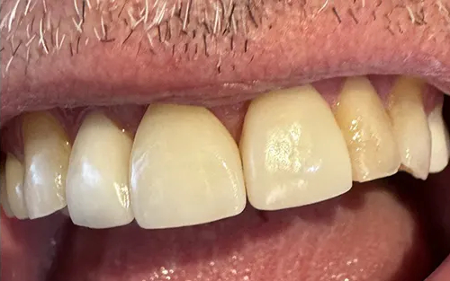 Restored smile with a natural-looking dental crown