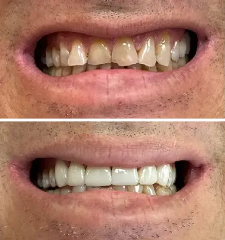 Darkened enamel, chipped edges, and an uneven smile line - Straight white teeth and a natural-looking result