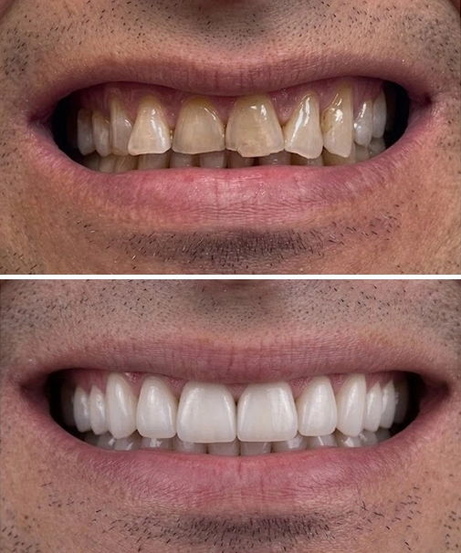 Worn Enamel · Porcelain Veneers