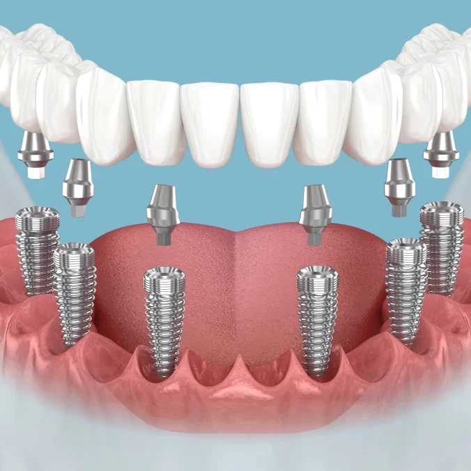 All-on-6 Dental implantation