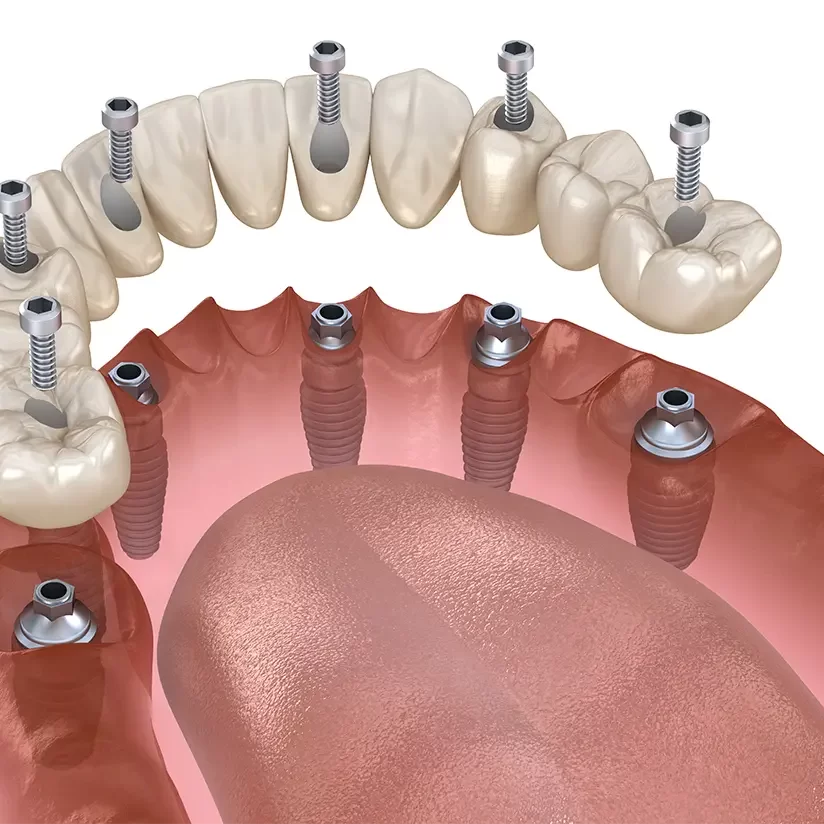 All-on-6 dental implants