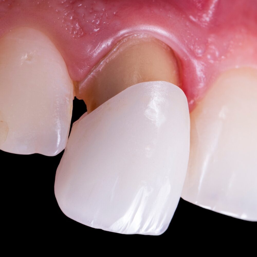 single ceramic tooth crown
