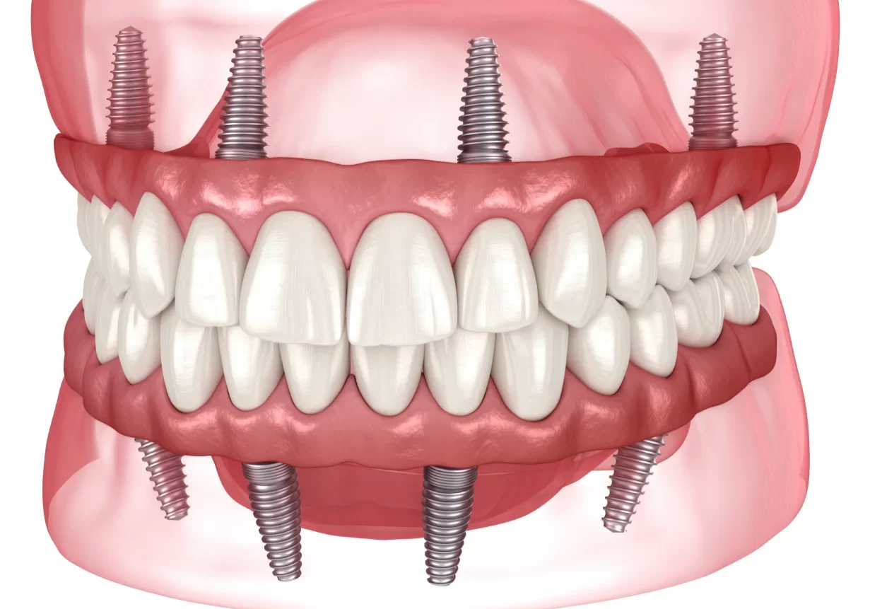 Implants All-on-4