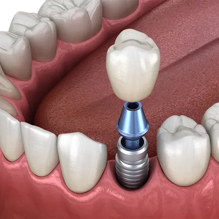 Traditional teeth implants