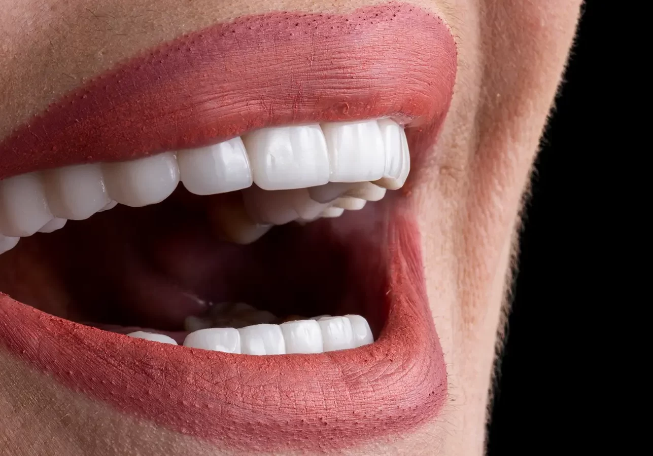 20 Veneers for $16,500 Special – 50% Off!