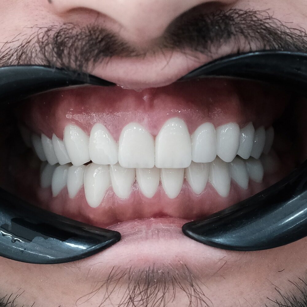 zirconia crowns on front teeth