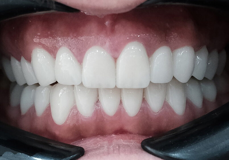 Close‑up of a patient’s teeth during a dental check‑up
