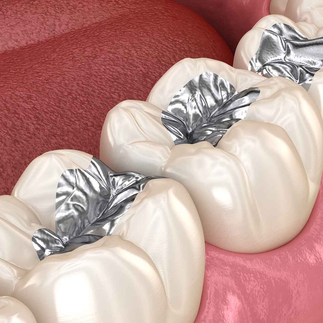 Dental mercury amalgam in molars