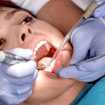 dental-sealants-570x350