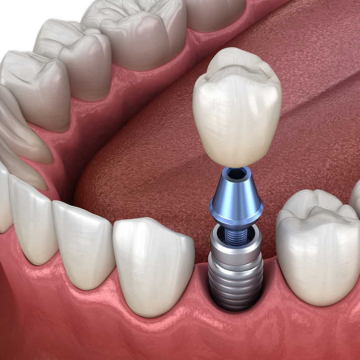 front tooth implant