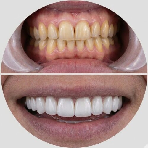 Porcelain veneers
