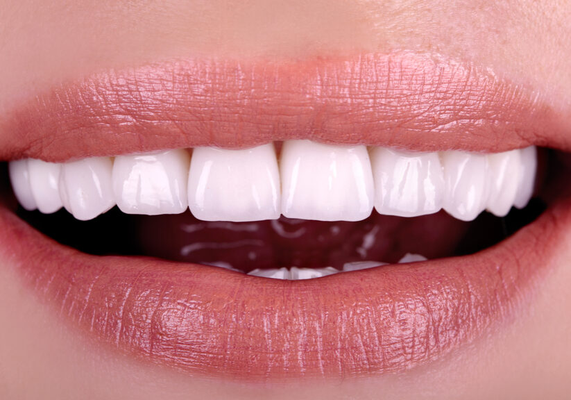 Perfect,Healthy,Teeth,Beautiful,Wide,Smile,Bleaching,Ceramic,Crowns,Whitening