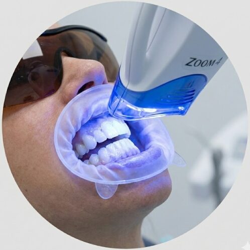 Teeth Whitening Zoom 4