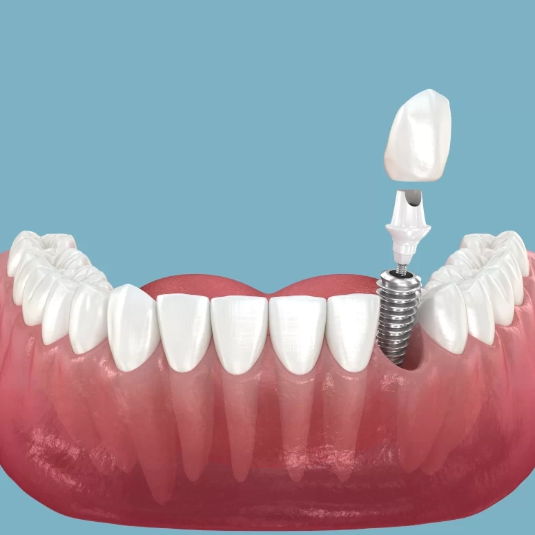 Traditional Teeth Implants